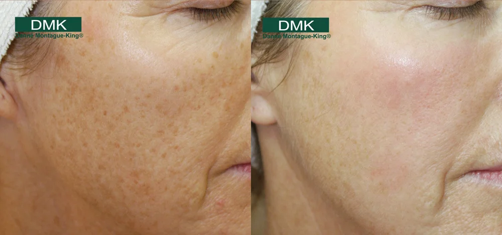 DMK Enzyme Facial in Sarasota