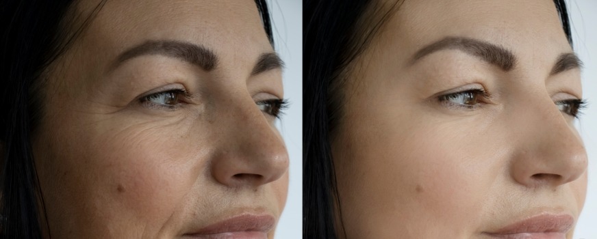 Microchanneling in Sarasoda FLorida