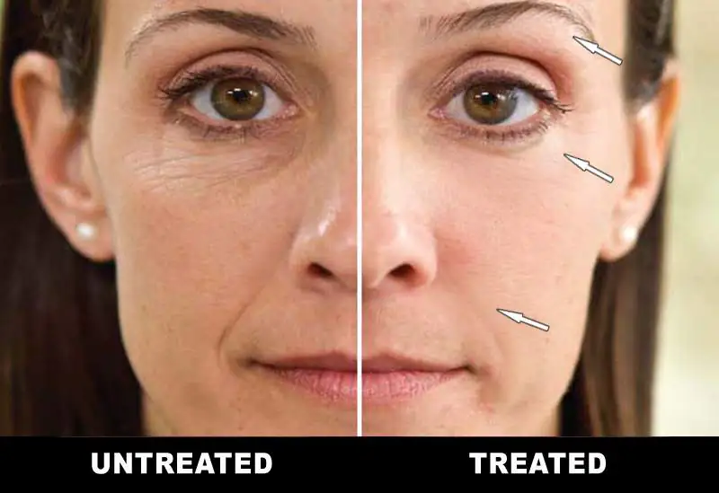 Neurotris™ Advanced Microcurrent: The Non-Invasive Facelift