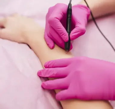 Unwanted hair removal